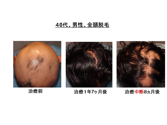 円形脱毛症　病院""